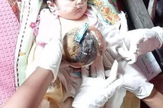 Bayi di Riau Ini Lahir dengan Organ Perut di Luar, Butuh Uluran Tangan Dermawan