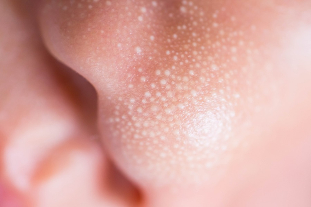 Milia atau Bintik Putih Pada Wajah Bayi, Normal atau Tidak?