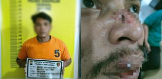 Sakit Hati Tak Dipinjam ATM, Hidung Dan Bibir Pemuda di Pekanbaru Ini Robek Kena Bogem