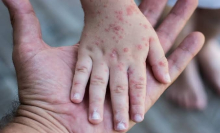 Pasien Monkeypox Pertama Dinyatakan Sembuh