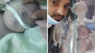 Geger! Bayi Bermata Satu Lahir di Yaman, Ini Penampakannya