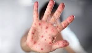 Kadiskes Riau: Virus Mpox Belum Terdeteksi di Riau, Warga Diminta Tetap Waspada