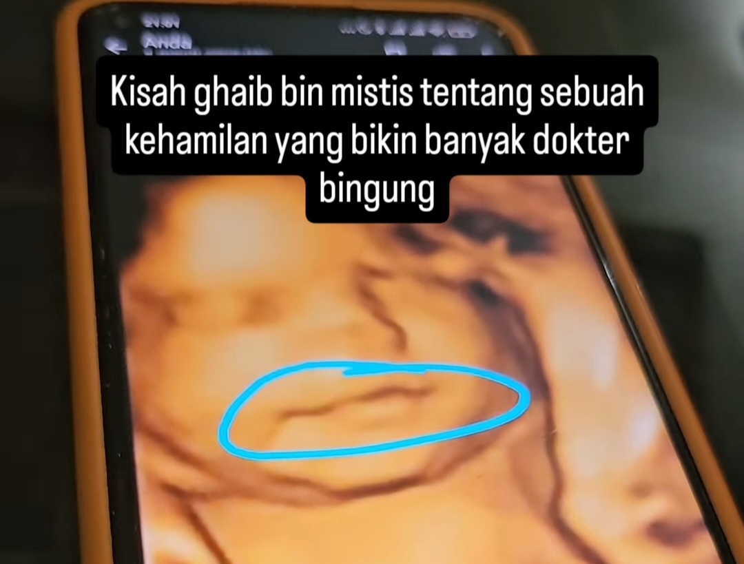 Dokter Kandungan Pekanbaru Ungkap Hal Diluar Nalar Medis, Bayi Dalam Kandungan Pasutri Raib Tiba-tiba