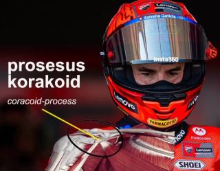 Marc Marquez Patah Tulang Bahu Kanan, Dipastikan Absen di Balapan Australia dan Malaysia